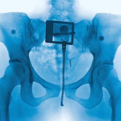 Pelvic X-ray with visible belt buckle, zipper wire and iud.